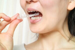 八重歯（ガタガタ歯）はマウスピース矯正で治せるの？