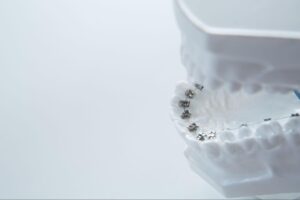 歯科矯正は医療費控除の対象になる？条件や申請方法、注意点を解説